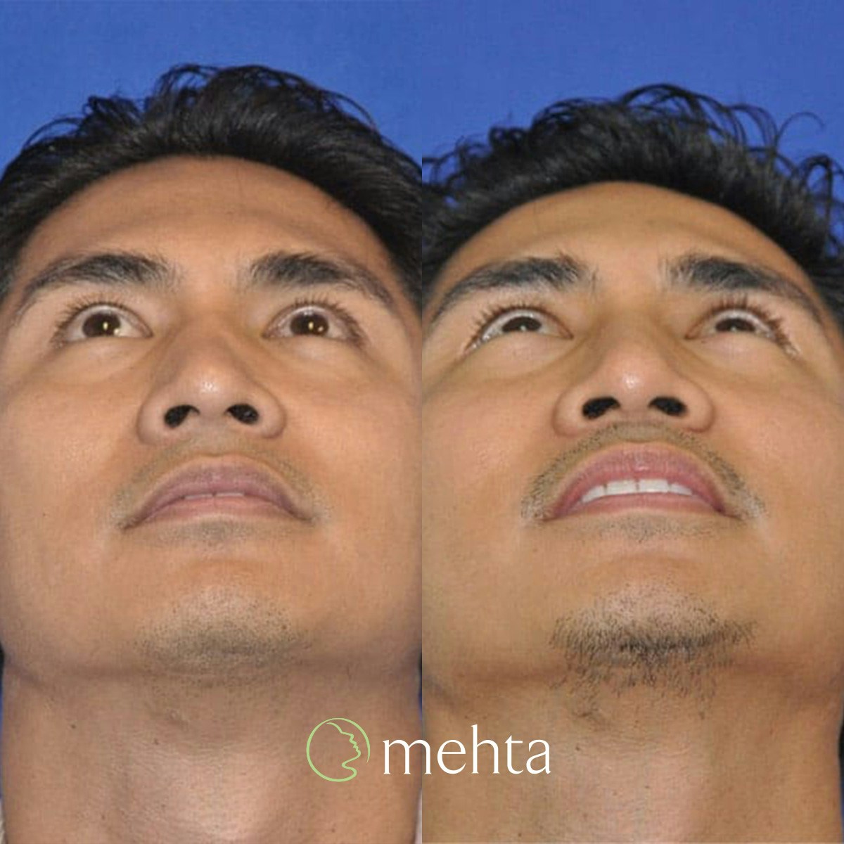 Rhinoplasty Before & After Gallery - Patient 961556 - Image 3