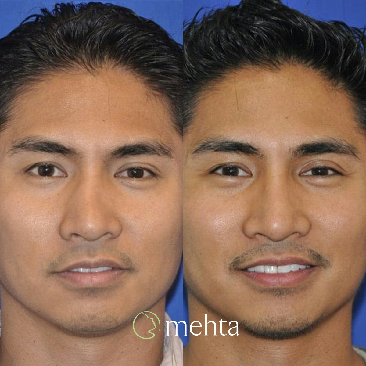 Rhinoplasty Before & After Gallery - Patient 961556 - Image 4