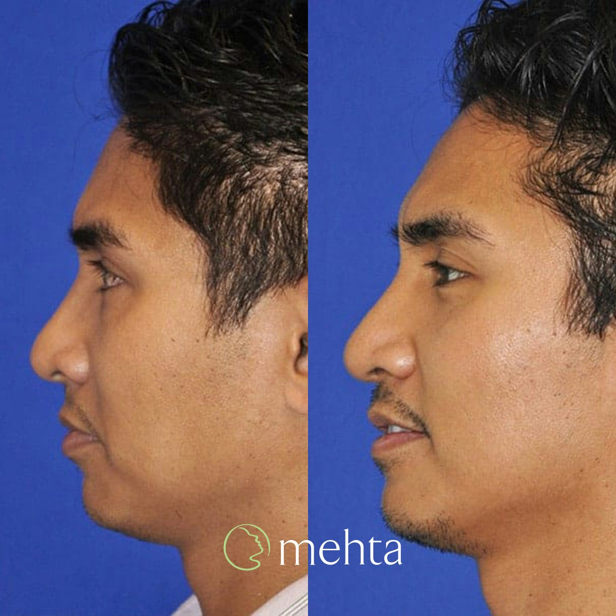 Rhinoplasty Before & After Gallery - Patient 961556 - Image 1