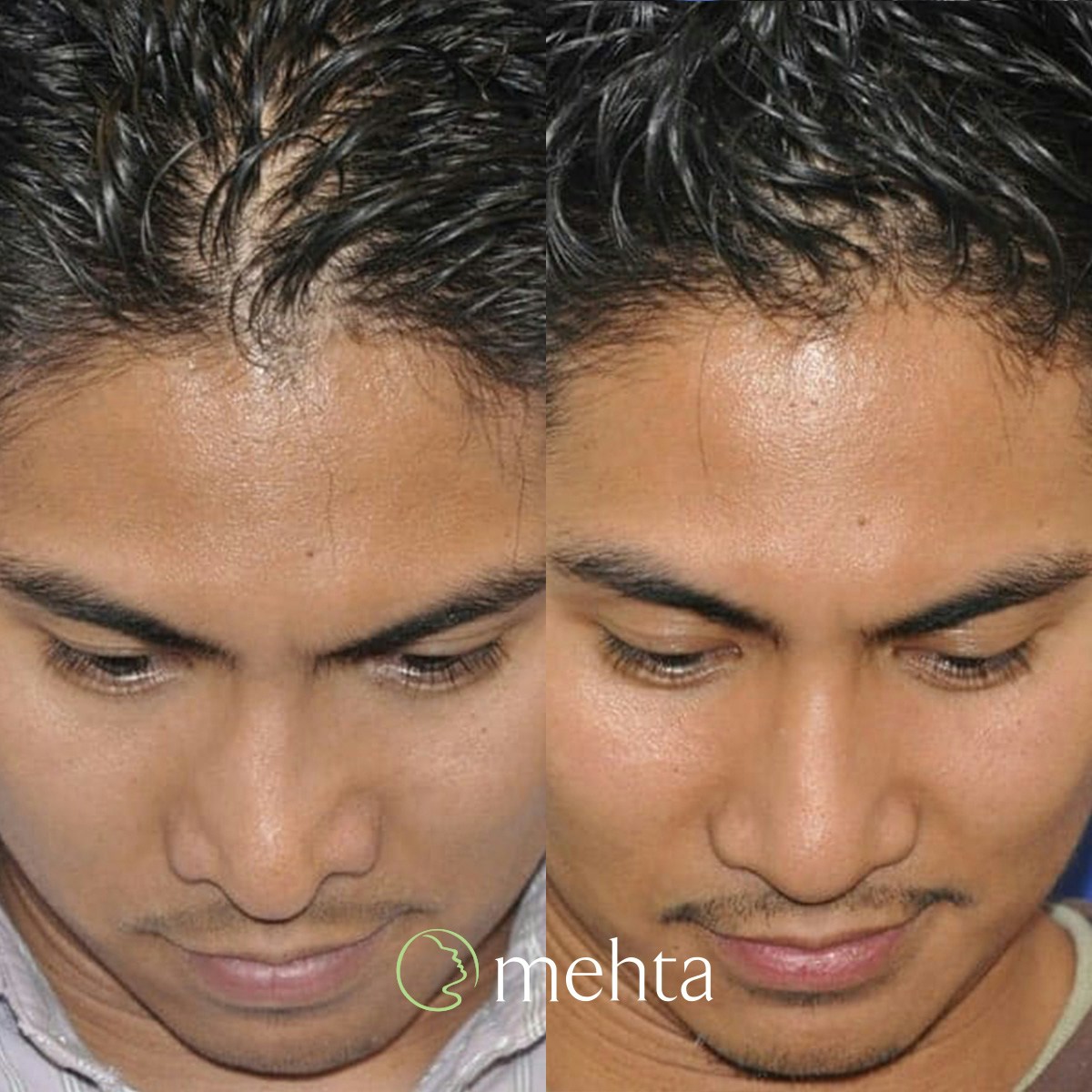 Rhinoplasty Before & After Gallery - Patient 961556 - Image 7