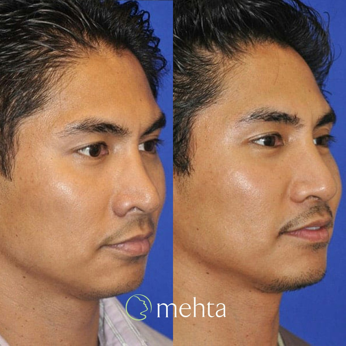 Rhinoplasty Before & After Gallery - Patient 961556 - Image 5
