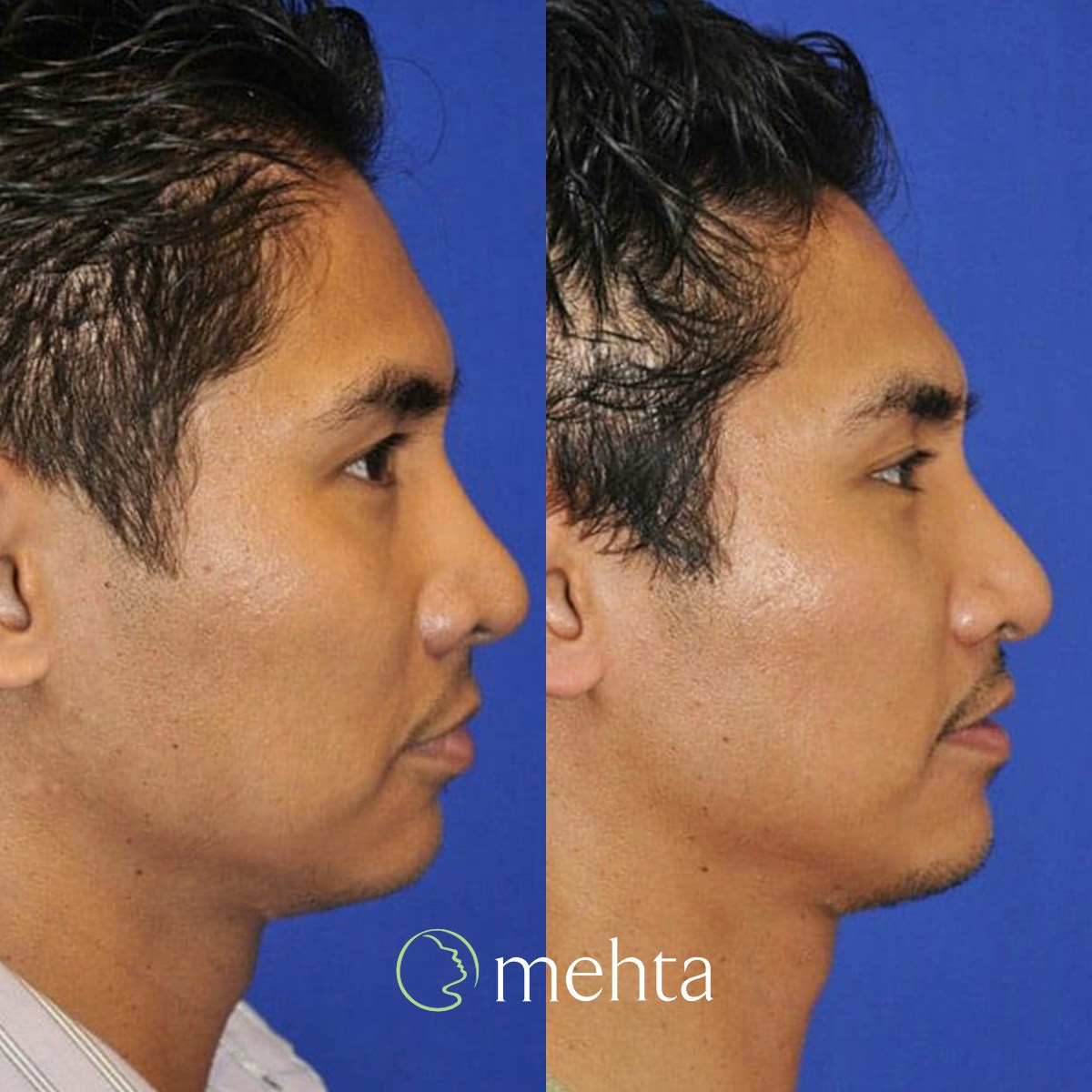 Rhinoplasty Before & After Gallery - Patient 961556 - Image 6