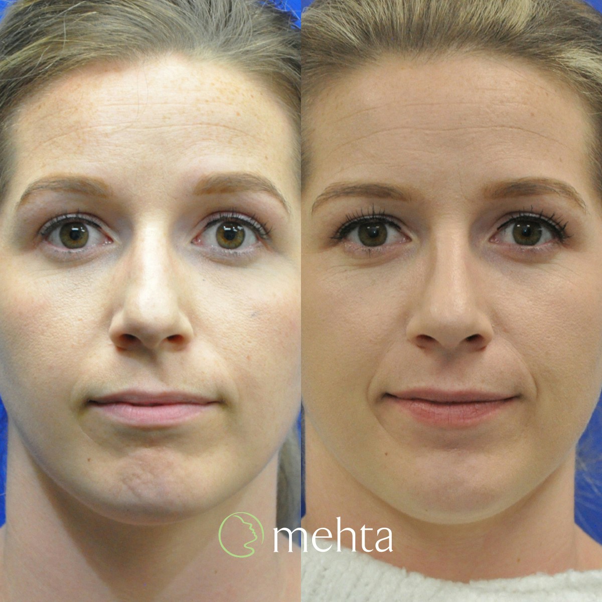Rhinoplasty Before & After Gallery - Patient 130935 - Image 2