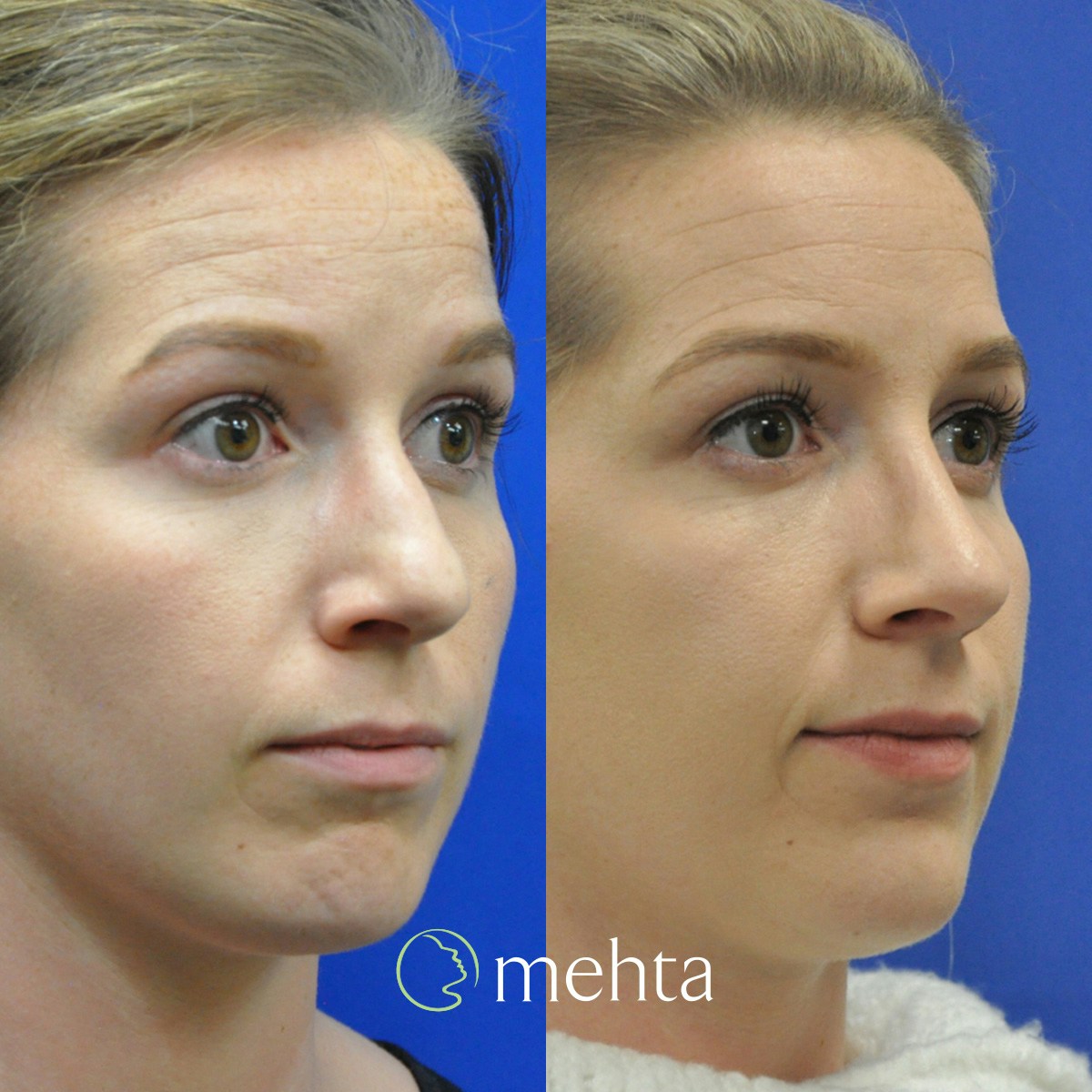 Rhinoplasty Before & After Gallery - Patient 130935 - Image 3