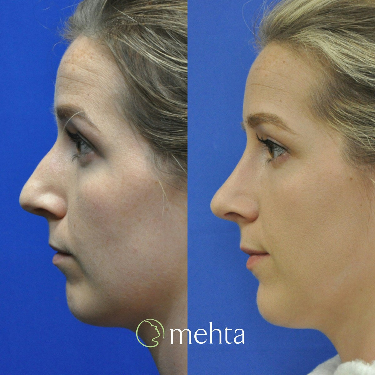 Rhinoplasty Before & After Gallery - Patient 130935 - Image 1