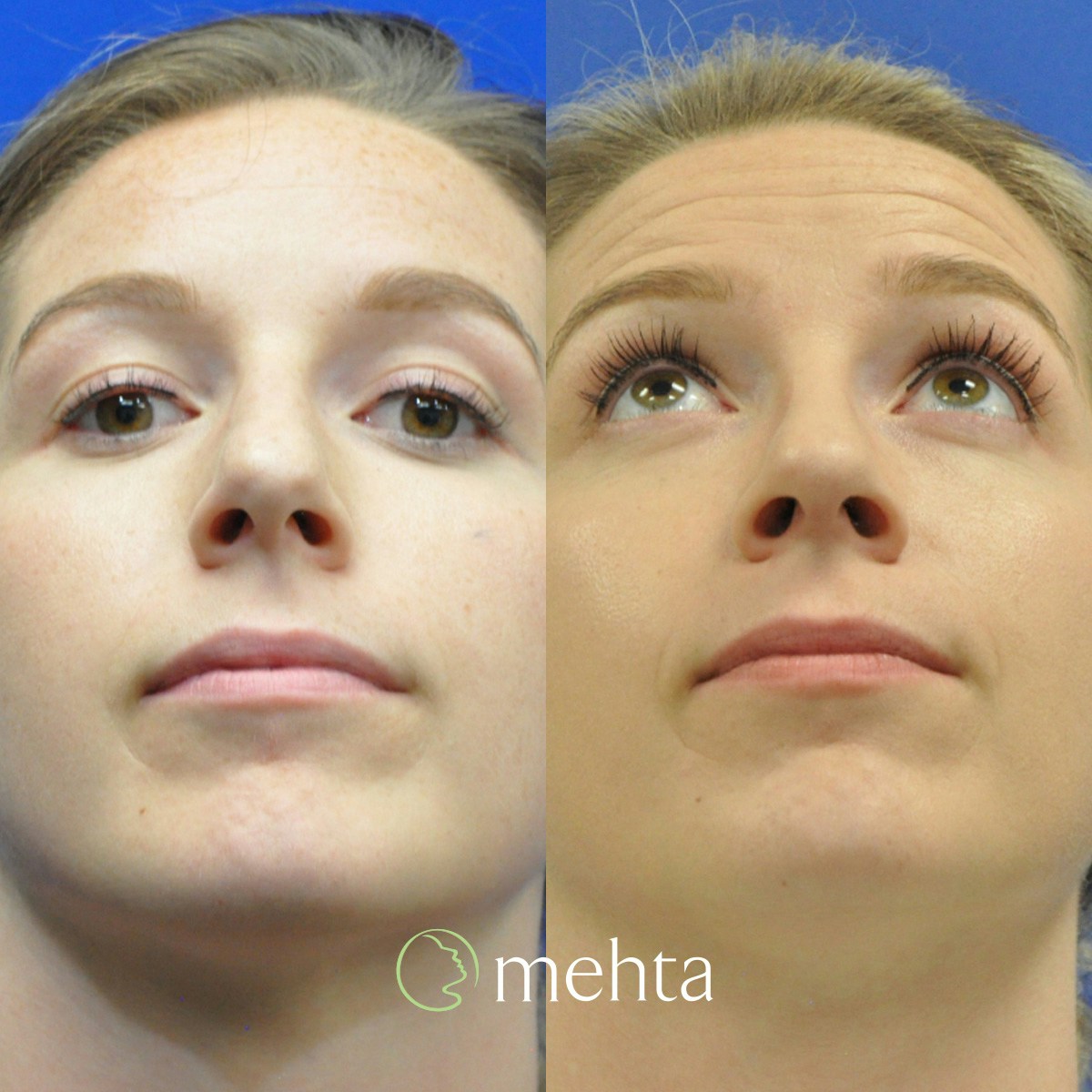 Rhinoplasty Before & After Gallery - Patient 130935 - Image 4