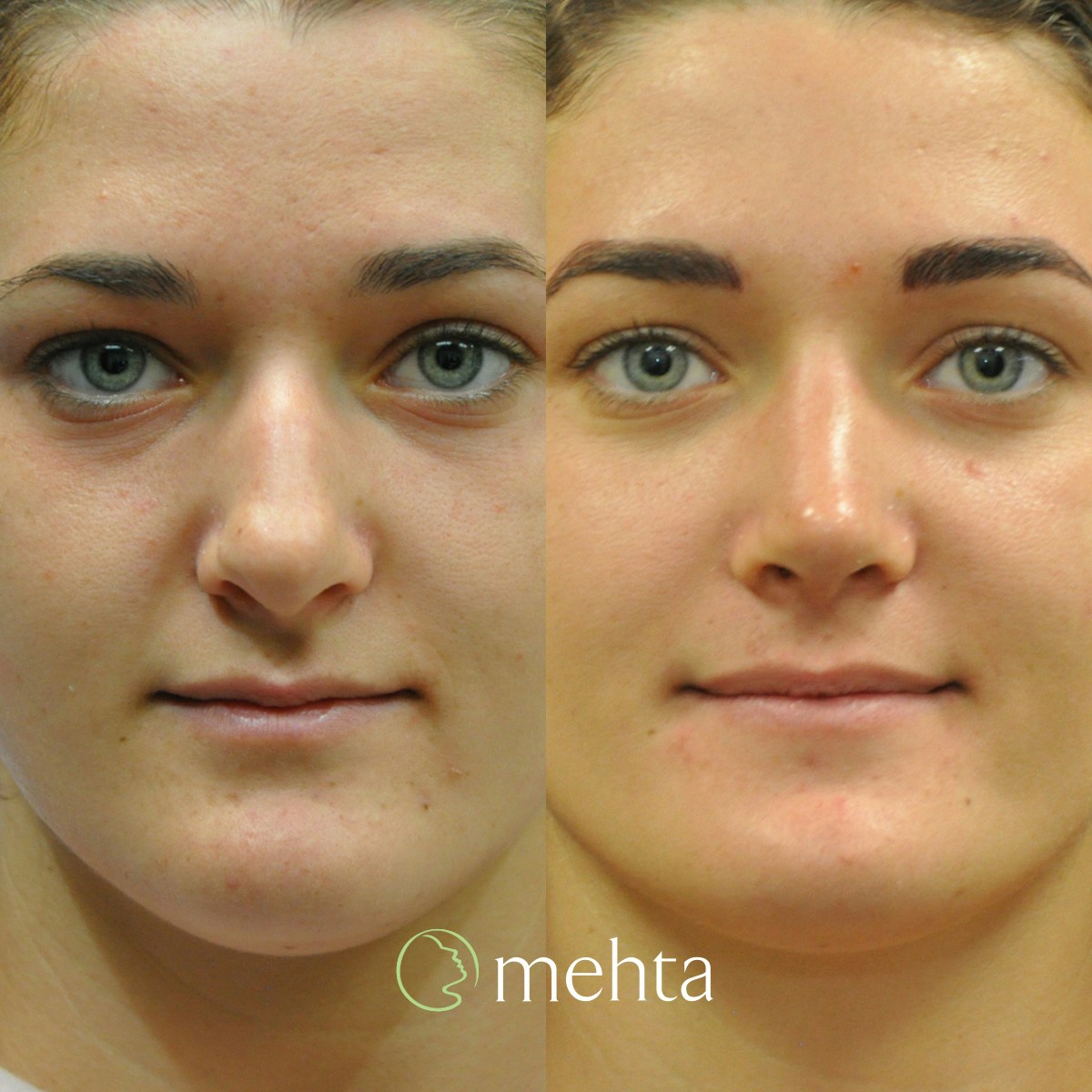 Rhinoplasty Before & After Gallery - Patient 280743 - Image 2