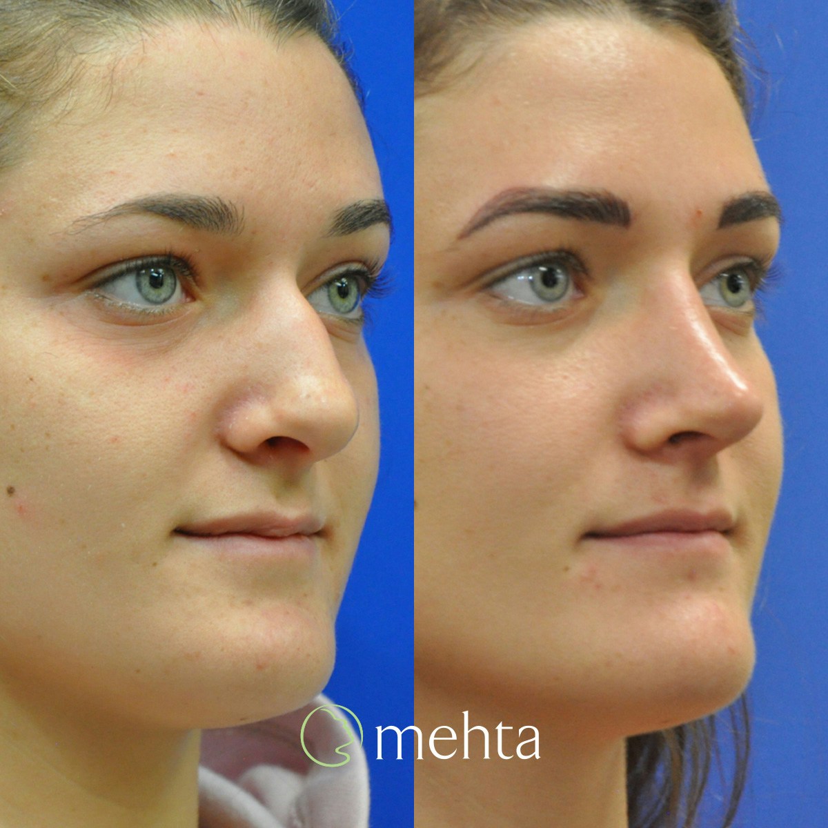 Rhinoplasty Before & After Gallery - Patient 280743 - Image 3