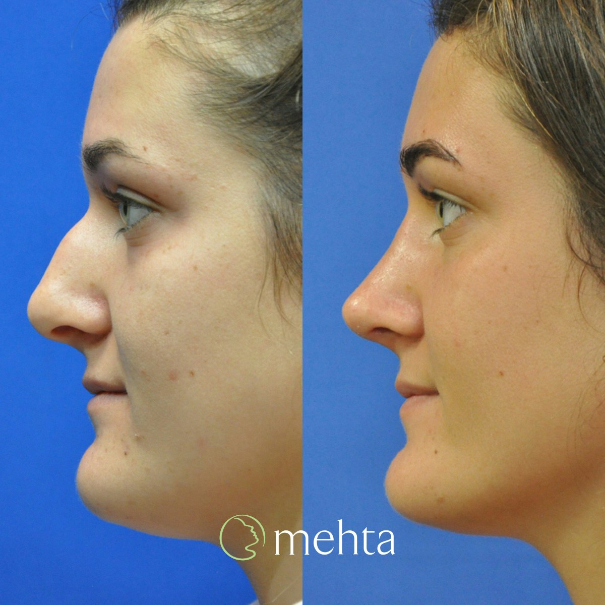 Rhinoplasty Before & After Gallery - Patient 280743 - Image 1