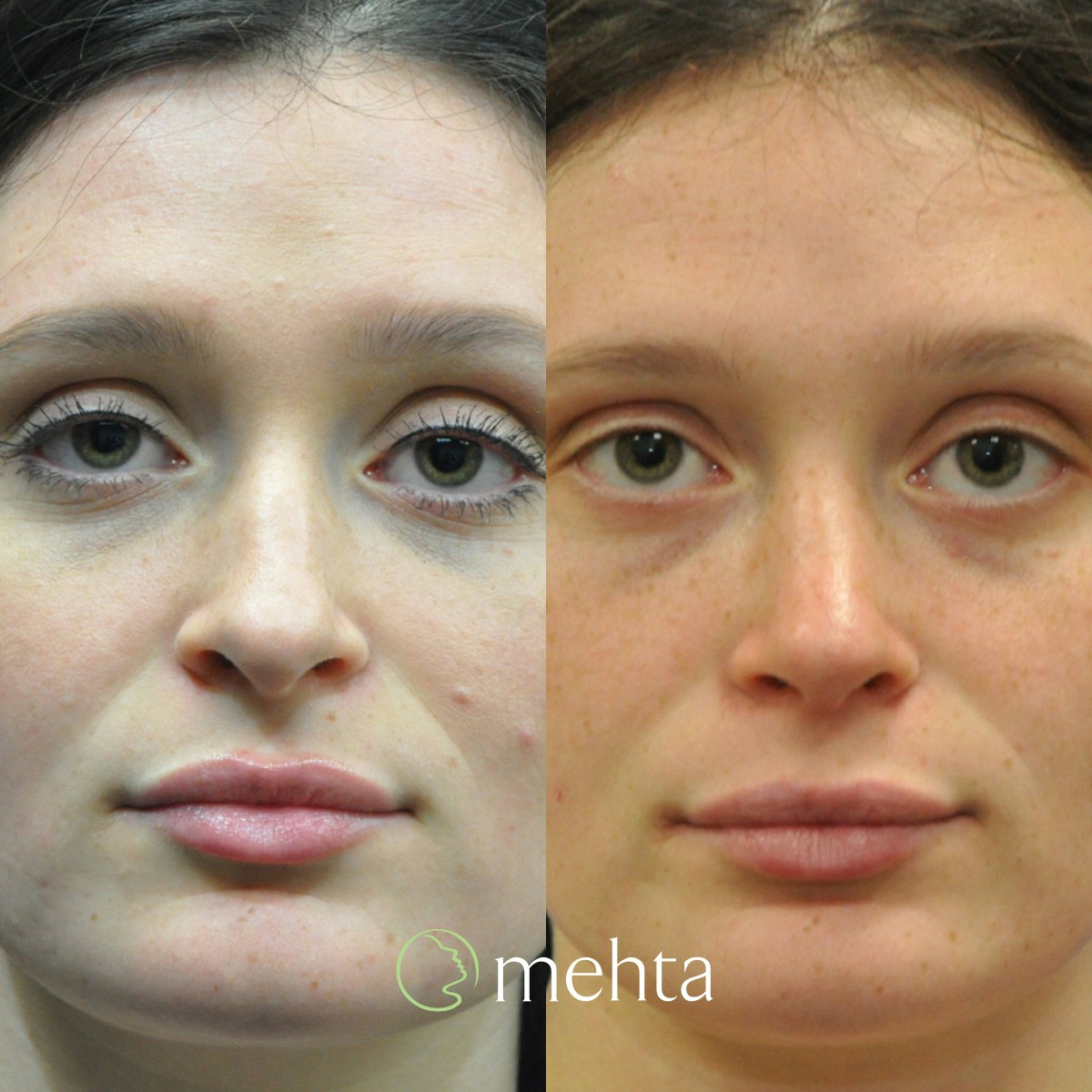Rhinoplasty Before & After Gallery - Patient 144707 - Image 3