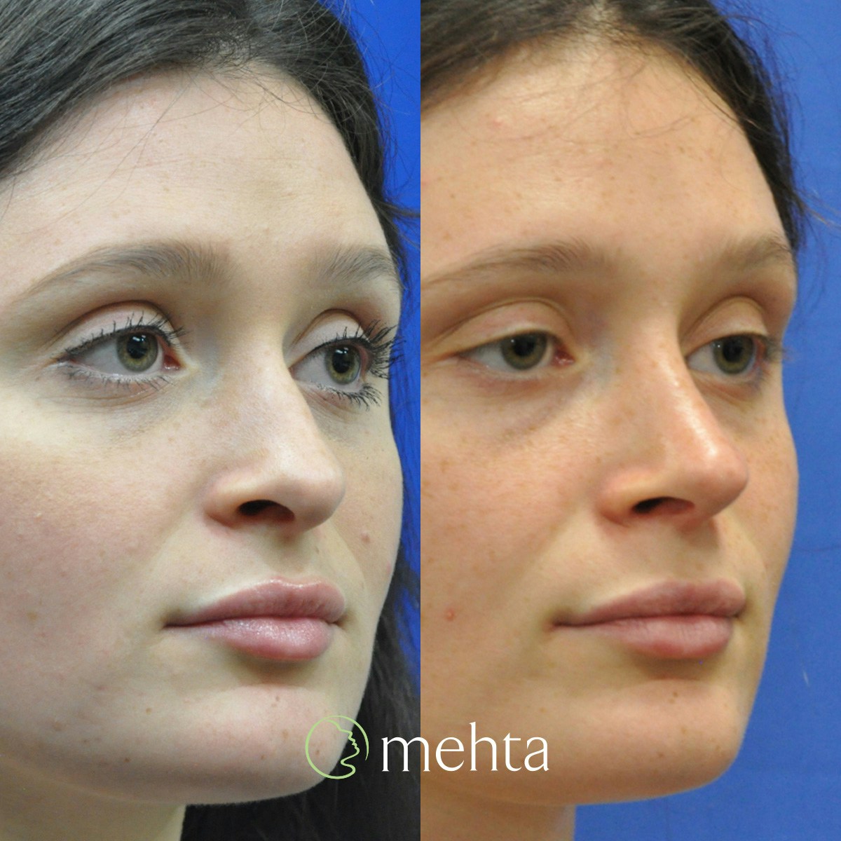 Rhinoplasty Before & After Gallery - Patient 144707 - Image 4