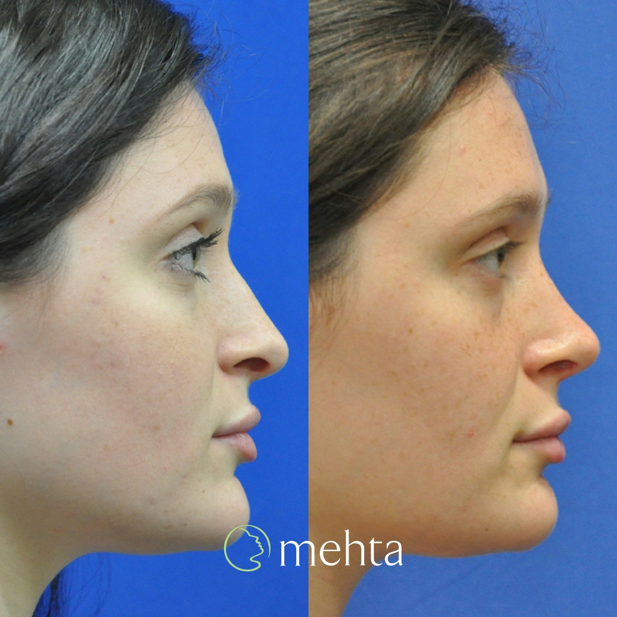 Rhinoplasty Before & After Gallery - Patient 144707 - Image 5
