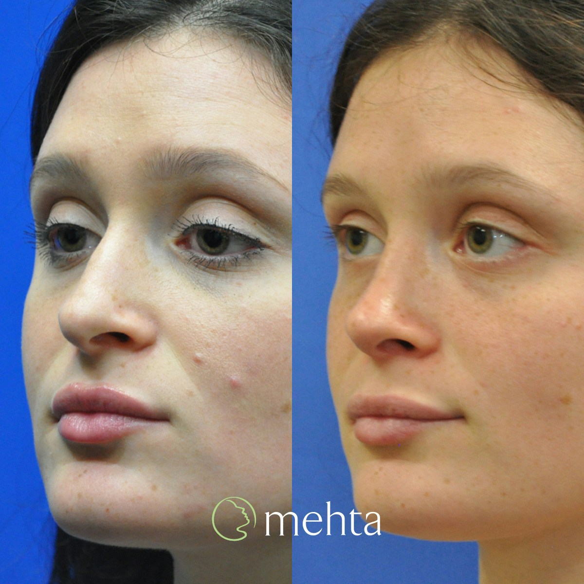 Rhinoplasty Before & After Gallery - Patient 144707 - Image 2