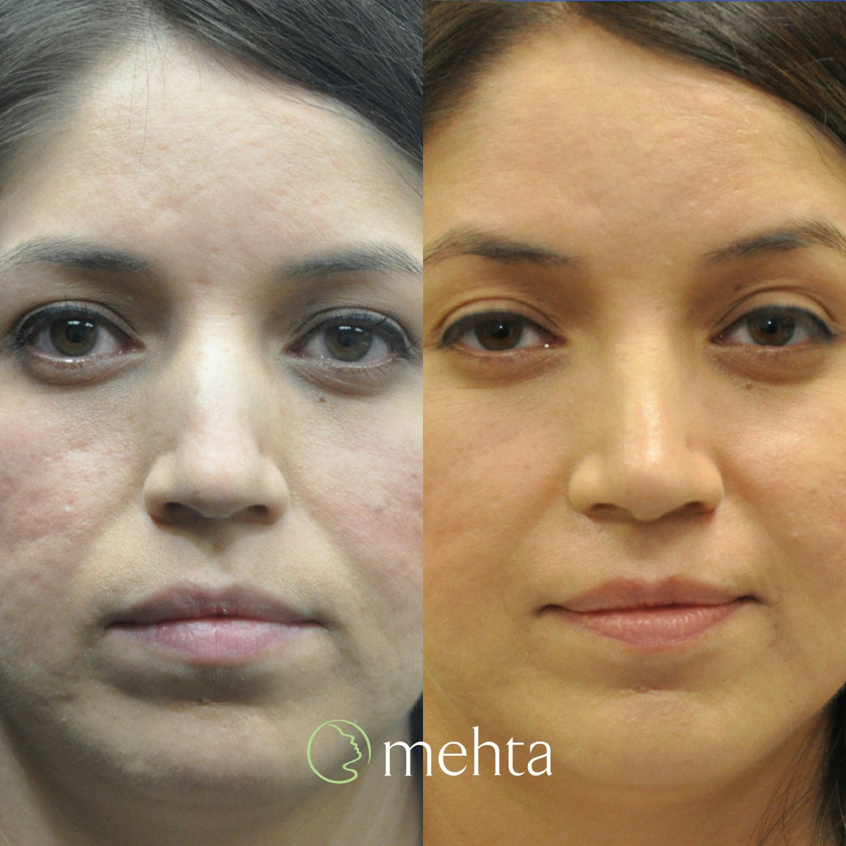 Rhinoplasty Before & After Gallery - Patient 188996 - Image 3