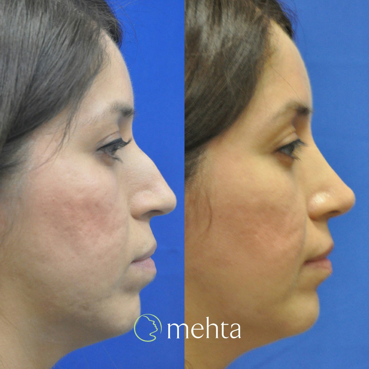 Rhinoplasty Before & After Gallery - Patient 188996 - Image 5