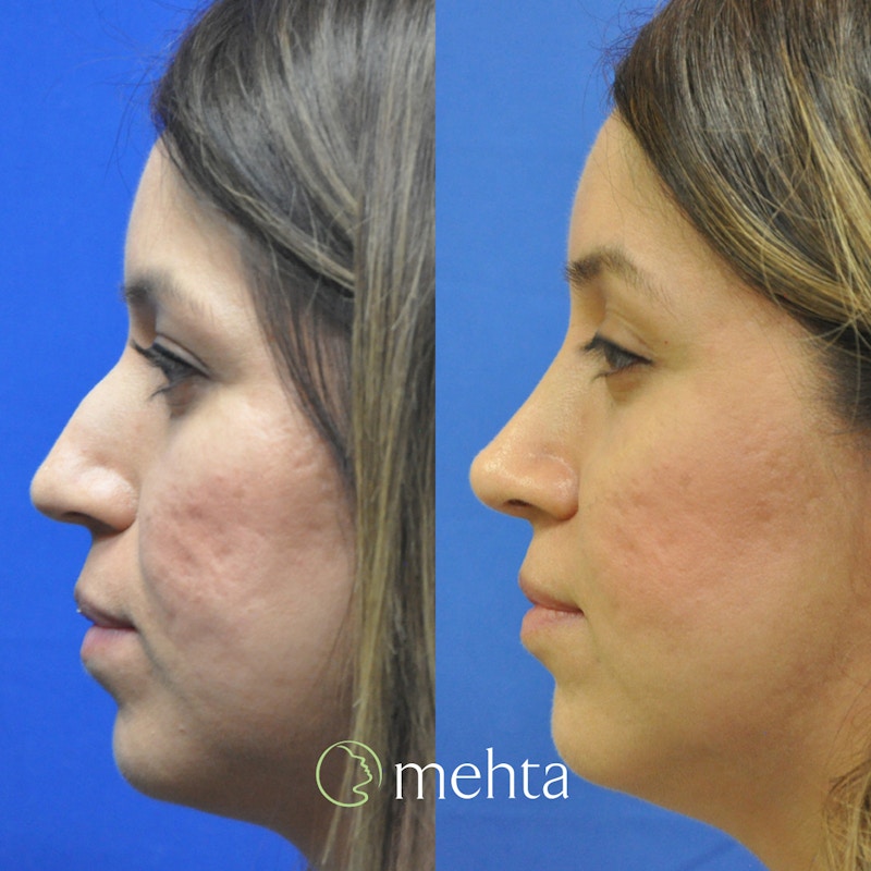 Rhinoplasty Before & After Gallery - Patient 188996 - Image 1