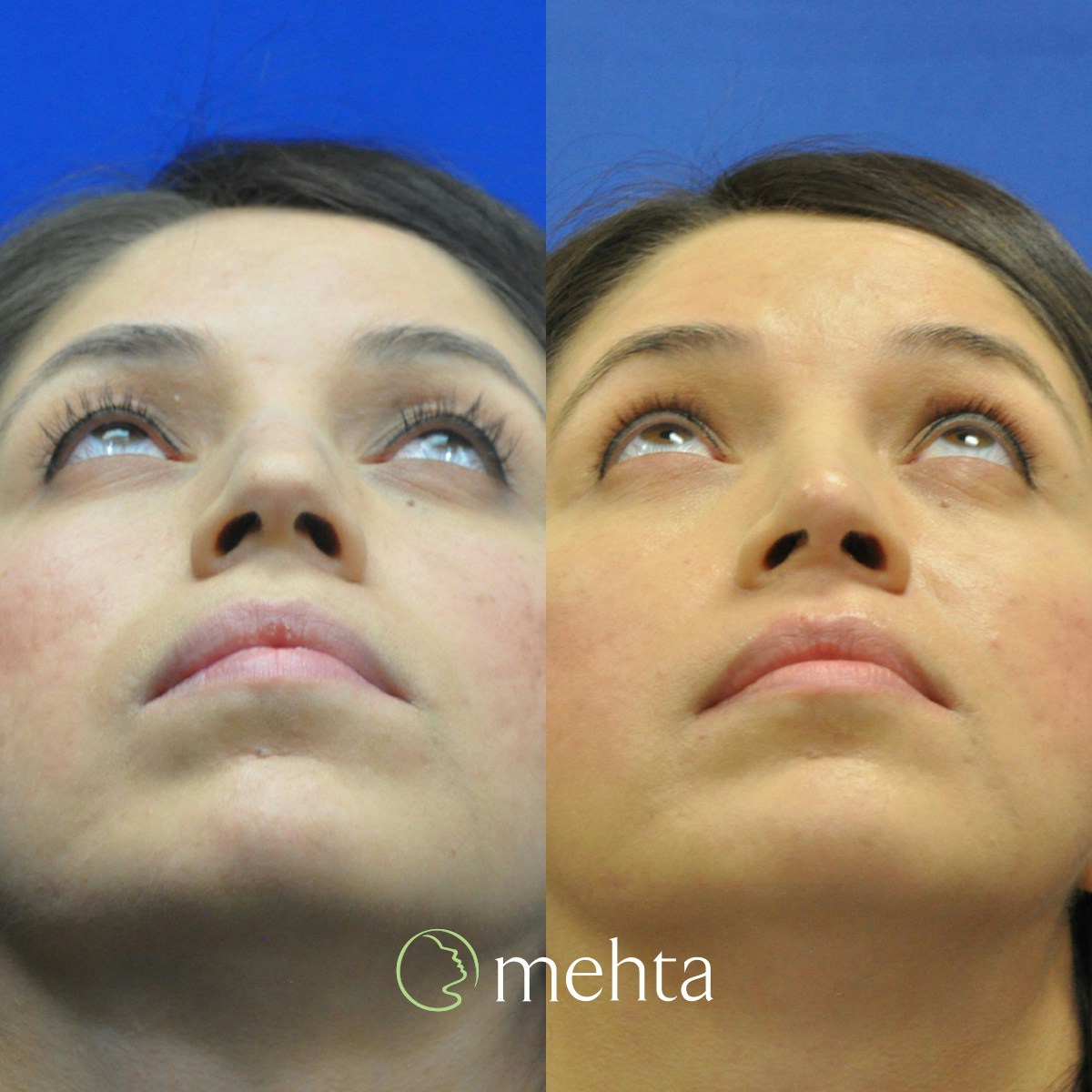 Rhinoplasty Before & After Gallery - Patient 188996 - Image 6