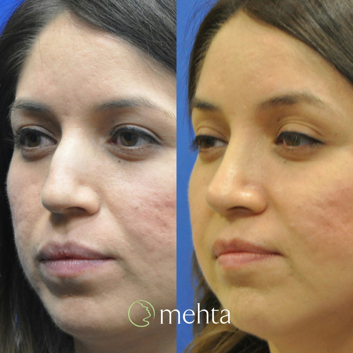 Rhinoplasty Before & After Gallery - Patient 188996 - Image 2