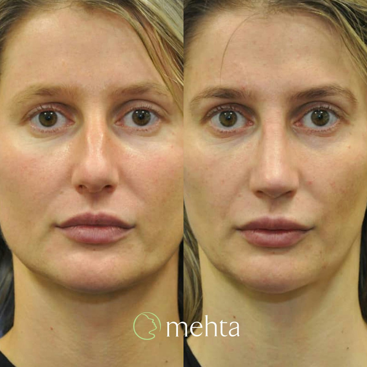 Rhinoplasty Before & After Gallery - Patient 142219 - Image 3