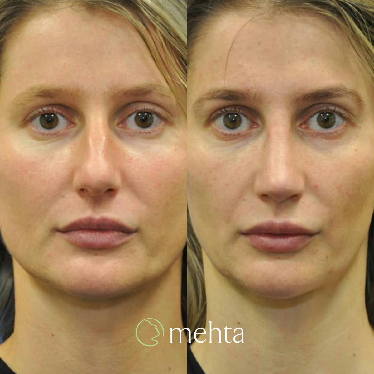 Rhinoplasty Before & After Gallery - Patient 142219 - Image 3