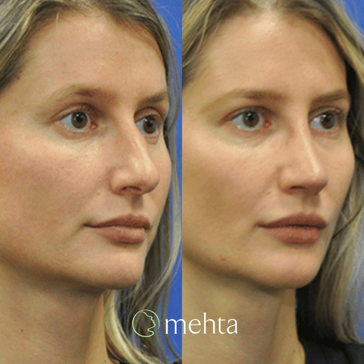 Rhinoplasty Before & After Gallery - Patient 142219 - Image 6