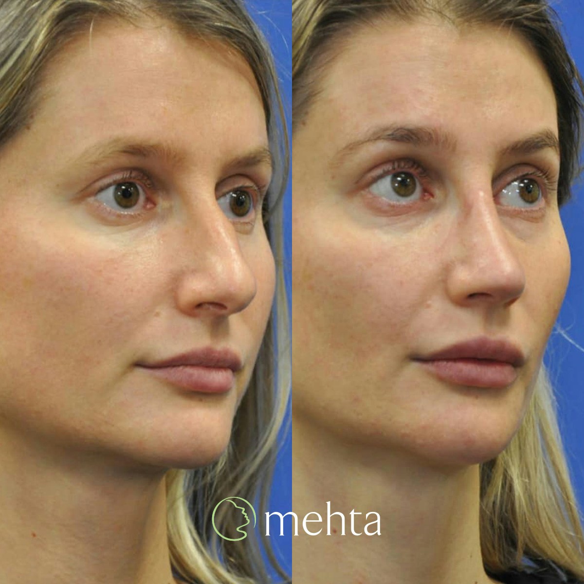 Rhinoplasty Before & After Gallery - Patient 142219 - Image 5