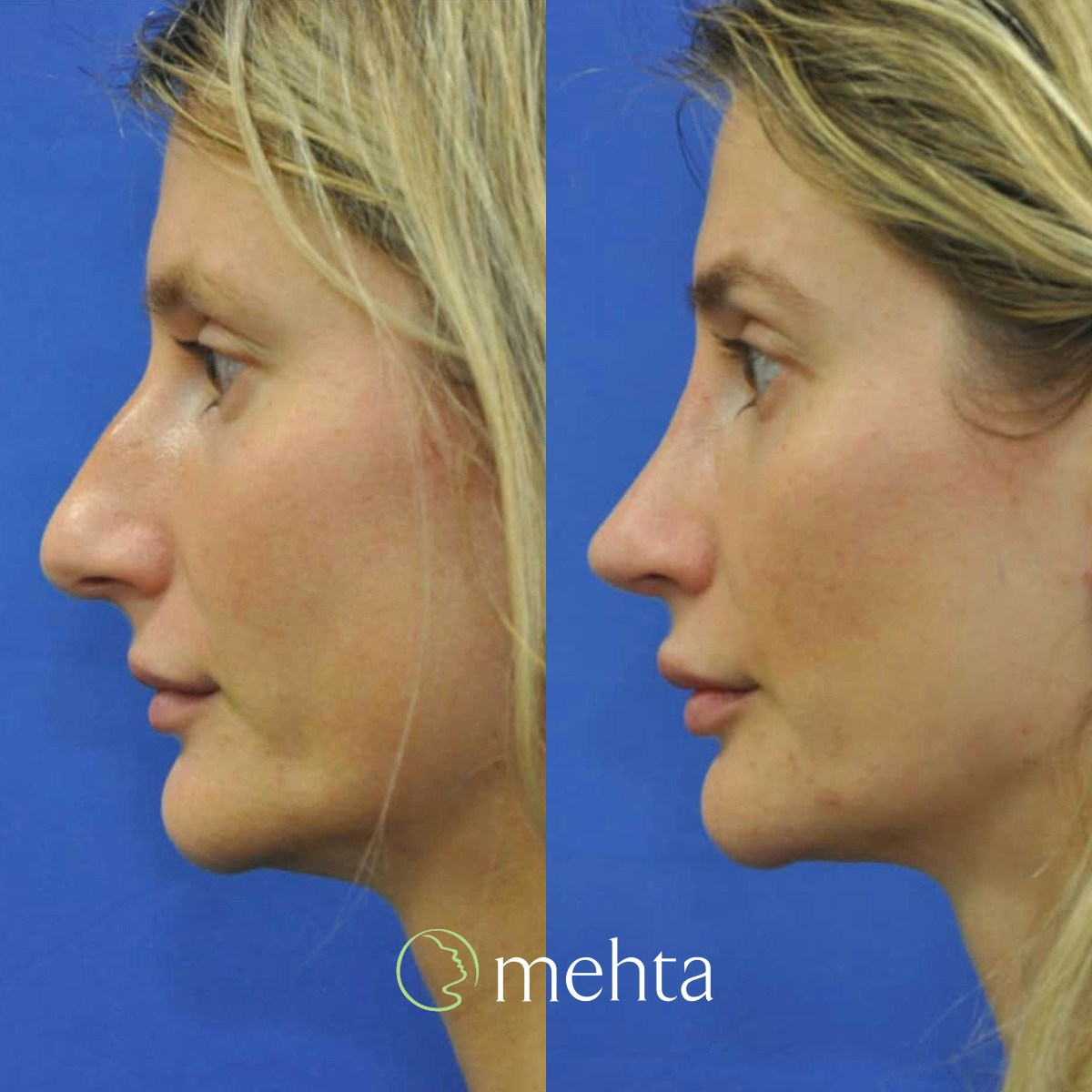 Rhinoplasty Before & After Gallery - Patient 142219 - Image 1