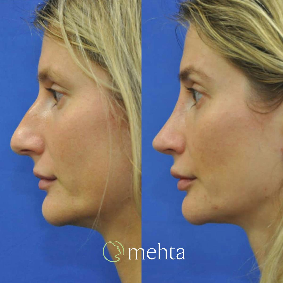 Rhinoplasty Before & After Gallery - Patient 142219 - Image 1