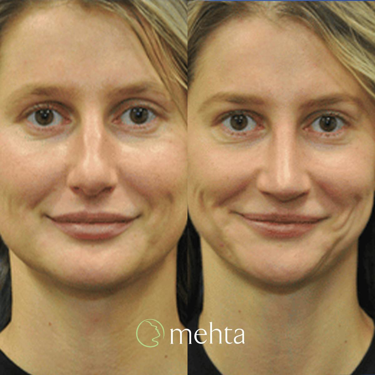 Rhinoplasty Before & After Gallery - Patient 142219 - Image 4