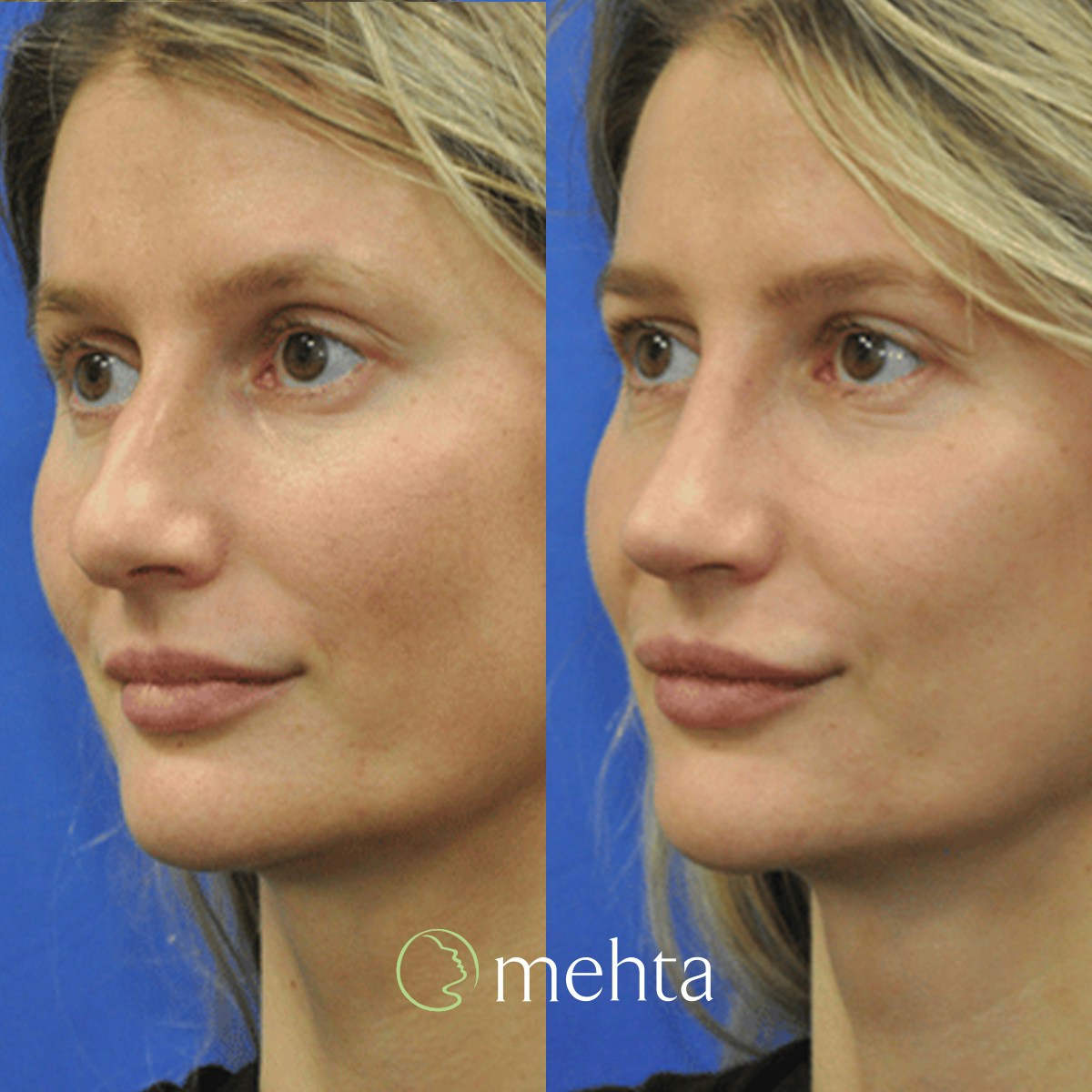 Rhinoplasty Before & After Gallery - Patient 142219 - Image 2