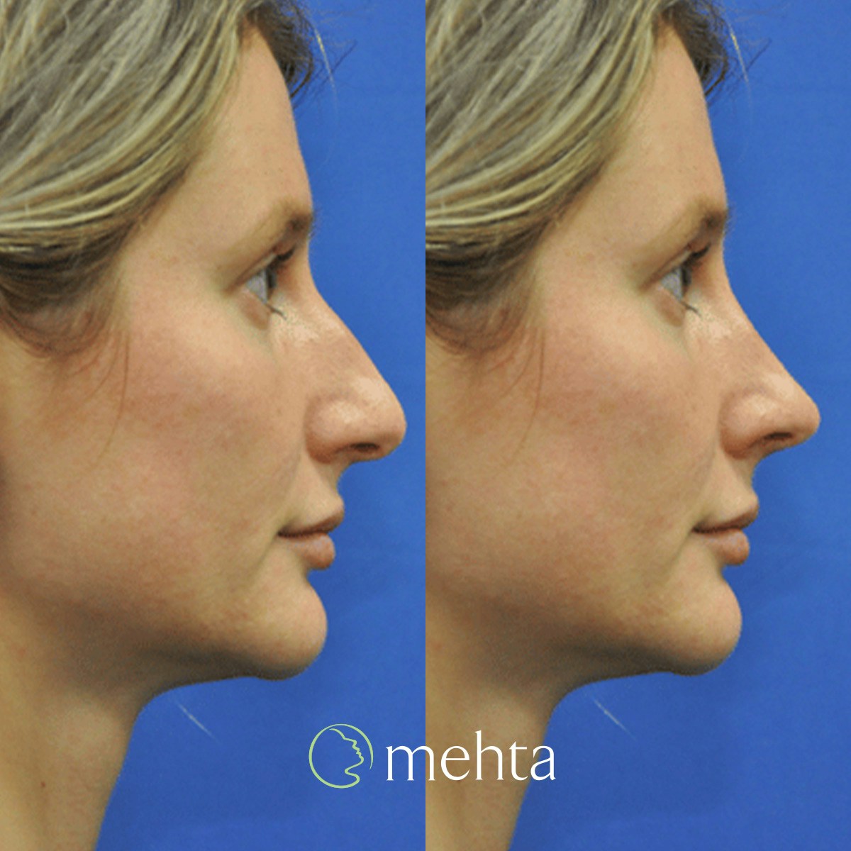 Rhinoplasty Before & After Gallery - Patient 142219 - Image 7