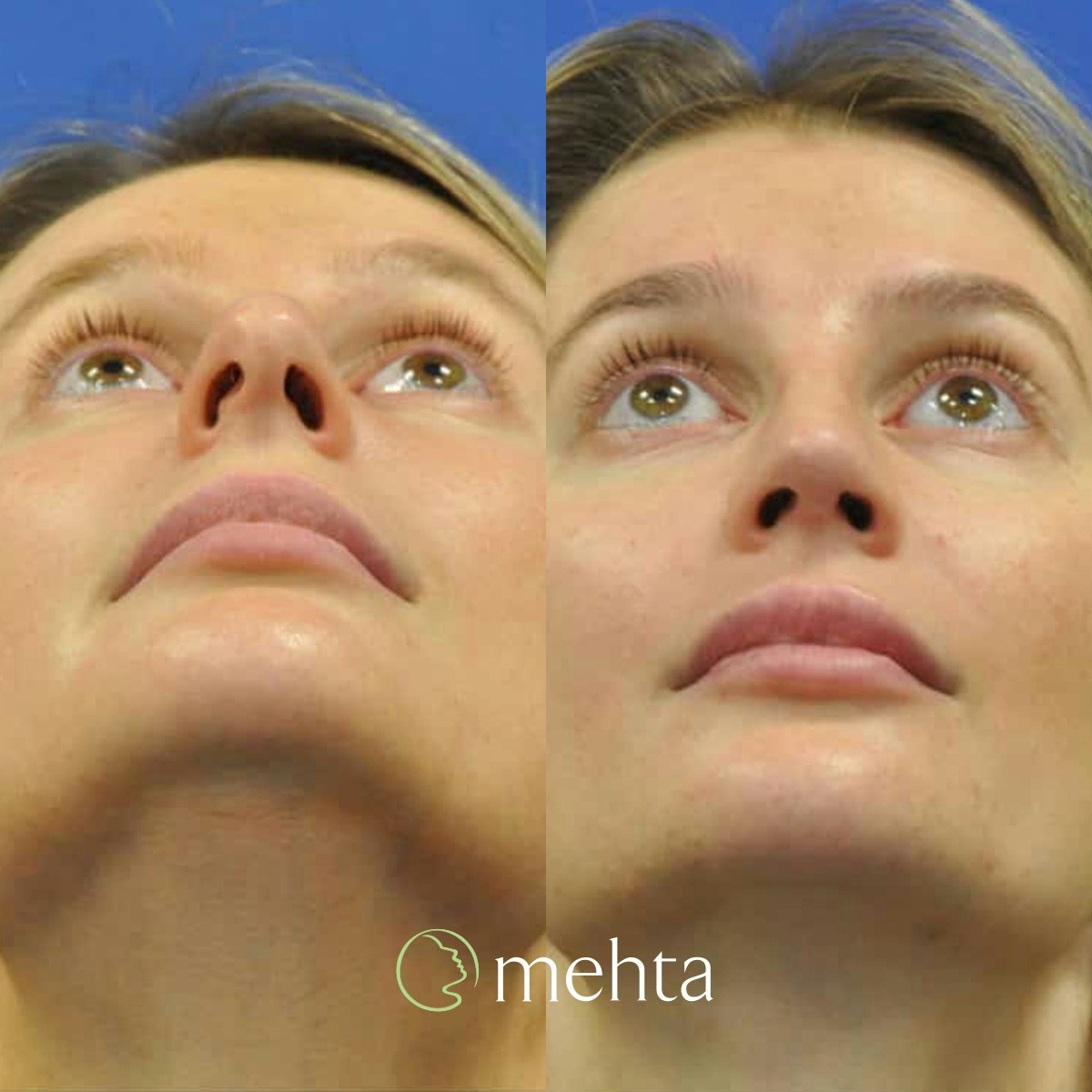 Rhinoplasty Before & After Gallery - Patient 142219 - Image 8