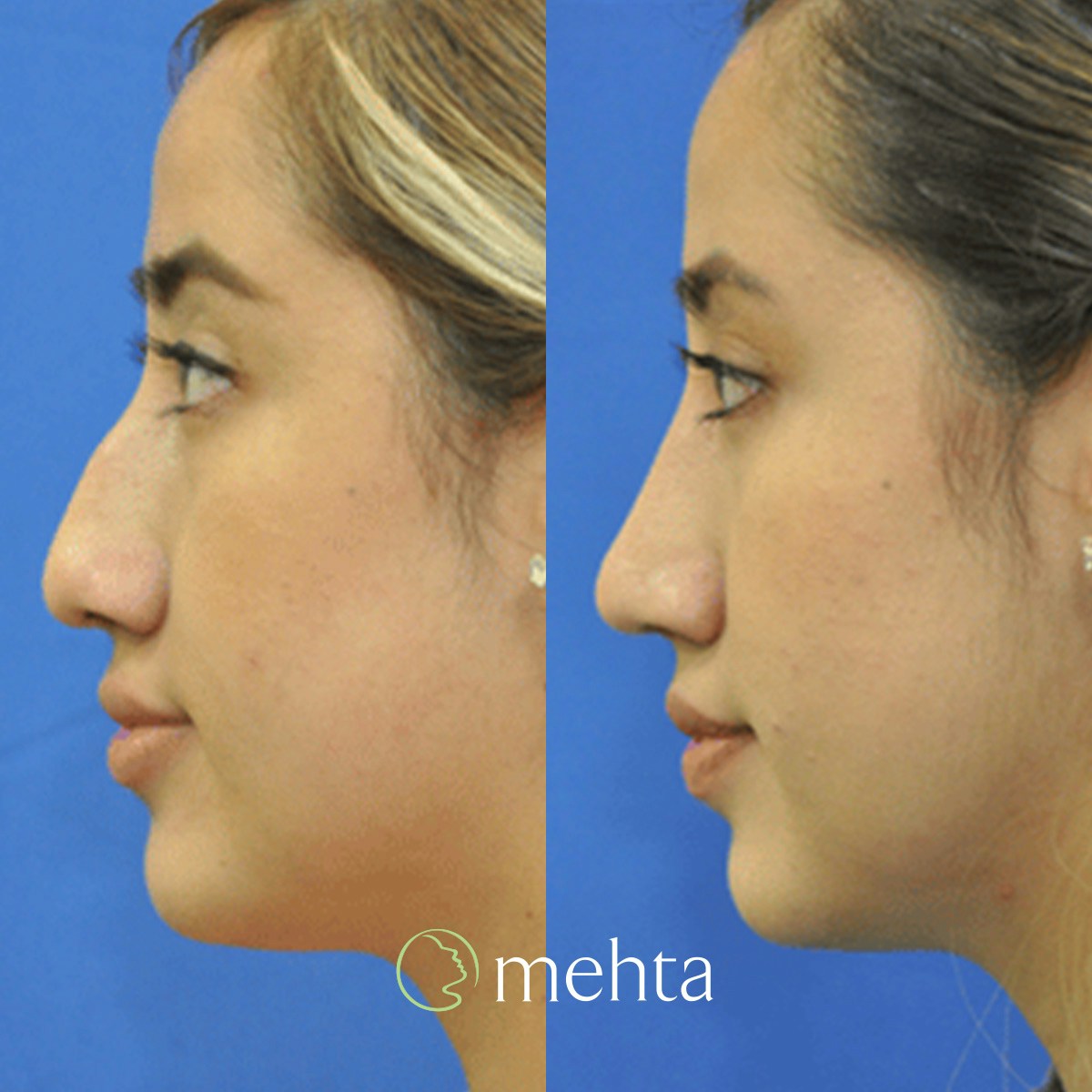 Rhinoplasty Before & After Gallery - Patient 408504 - Image 1