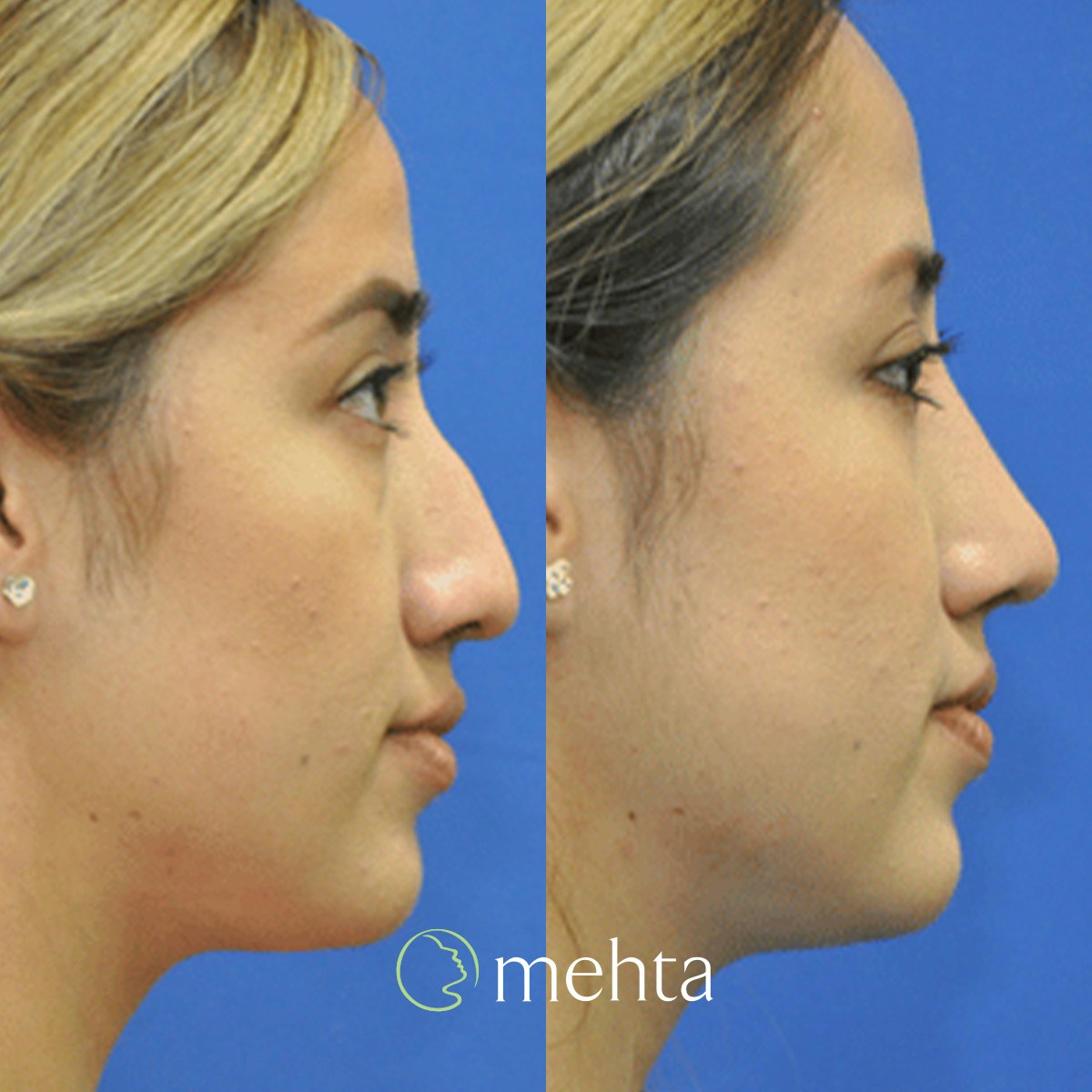Rhinoplasty Before & After Gallery - Patient 408504 - Image 4