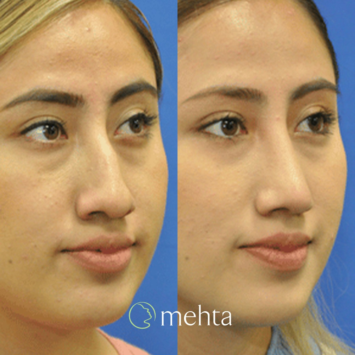 Rhinoplasty Before & After Gallery - Patient 408504 - Image 3