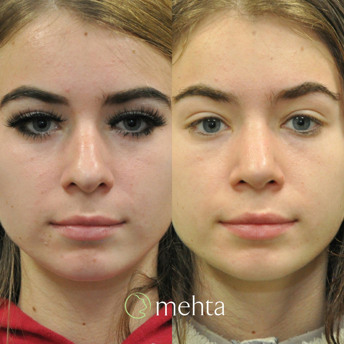Rhinoplasty Before & After Gallery - Patient 332653 - Image 3