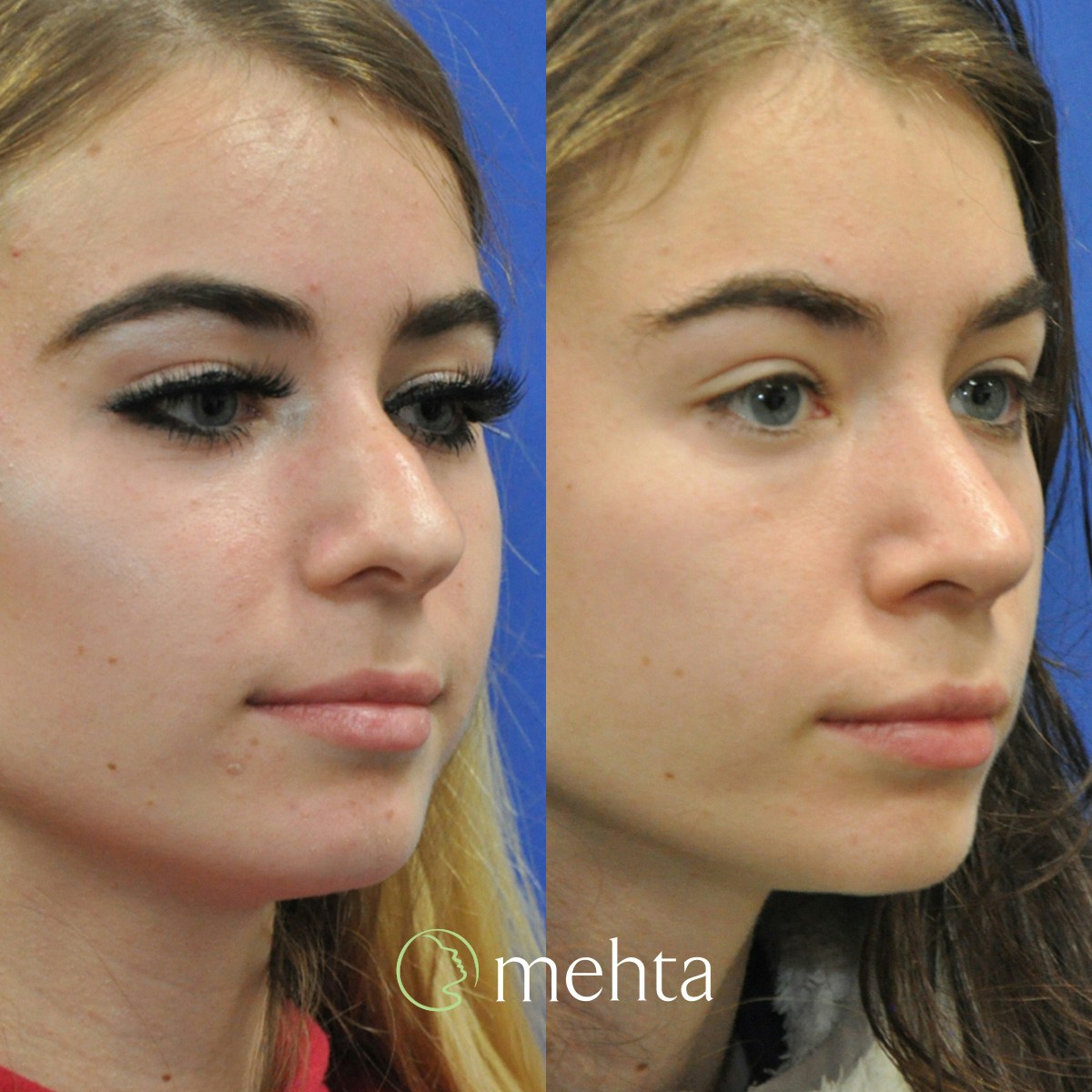 Rhinoplasty Before & After Gallery - Patient 332653 - Image 4