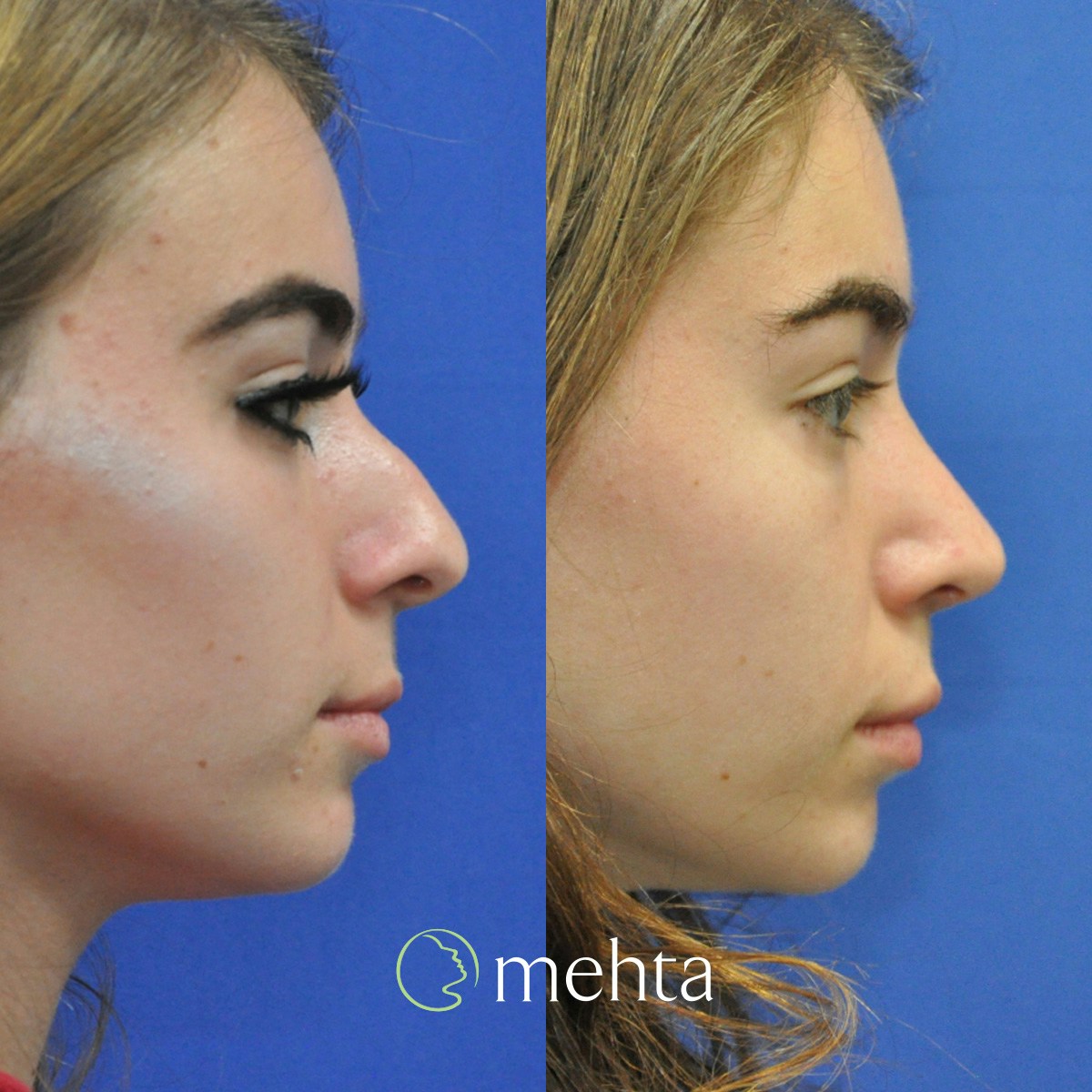 Rhinoplasty Before & After Gallery - Patient 332653 - Image 5