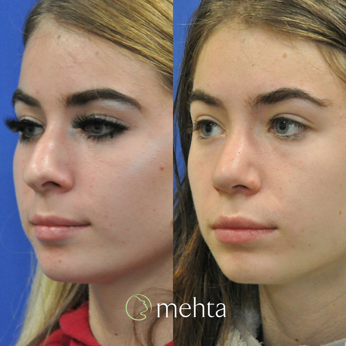 Rhinoplasty Before & After Gallery - Patient 332653 - Image 2