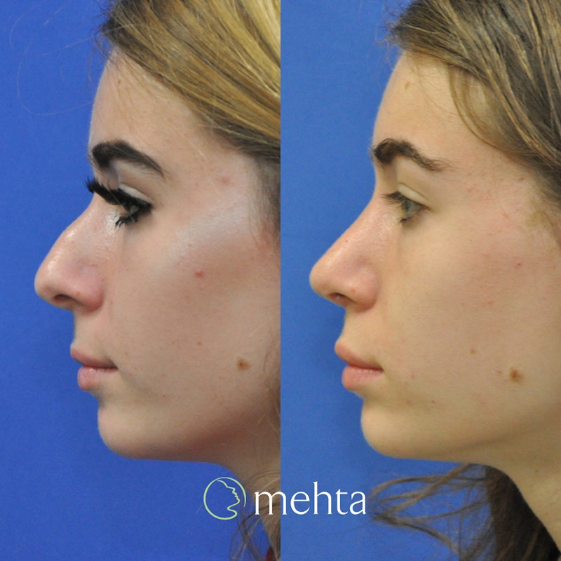 Rhinoplasty Before & After Gallery - Patient 332653 - Image 1