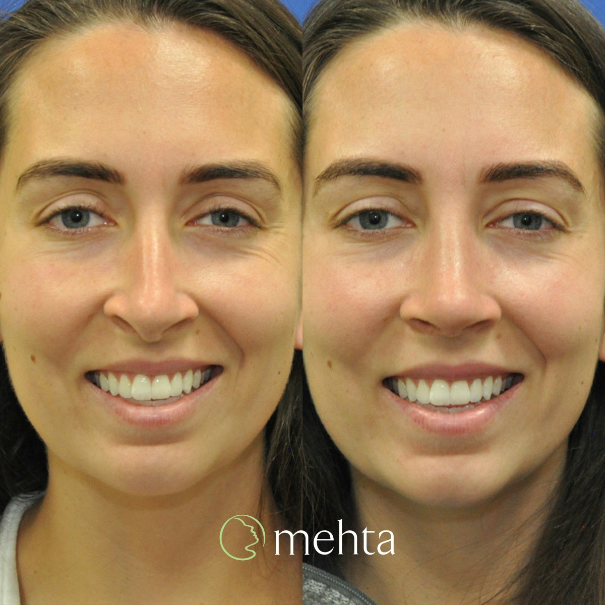 Rhinoplasty Before & After Gallery - Patient 259110 - Image 2