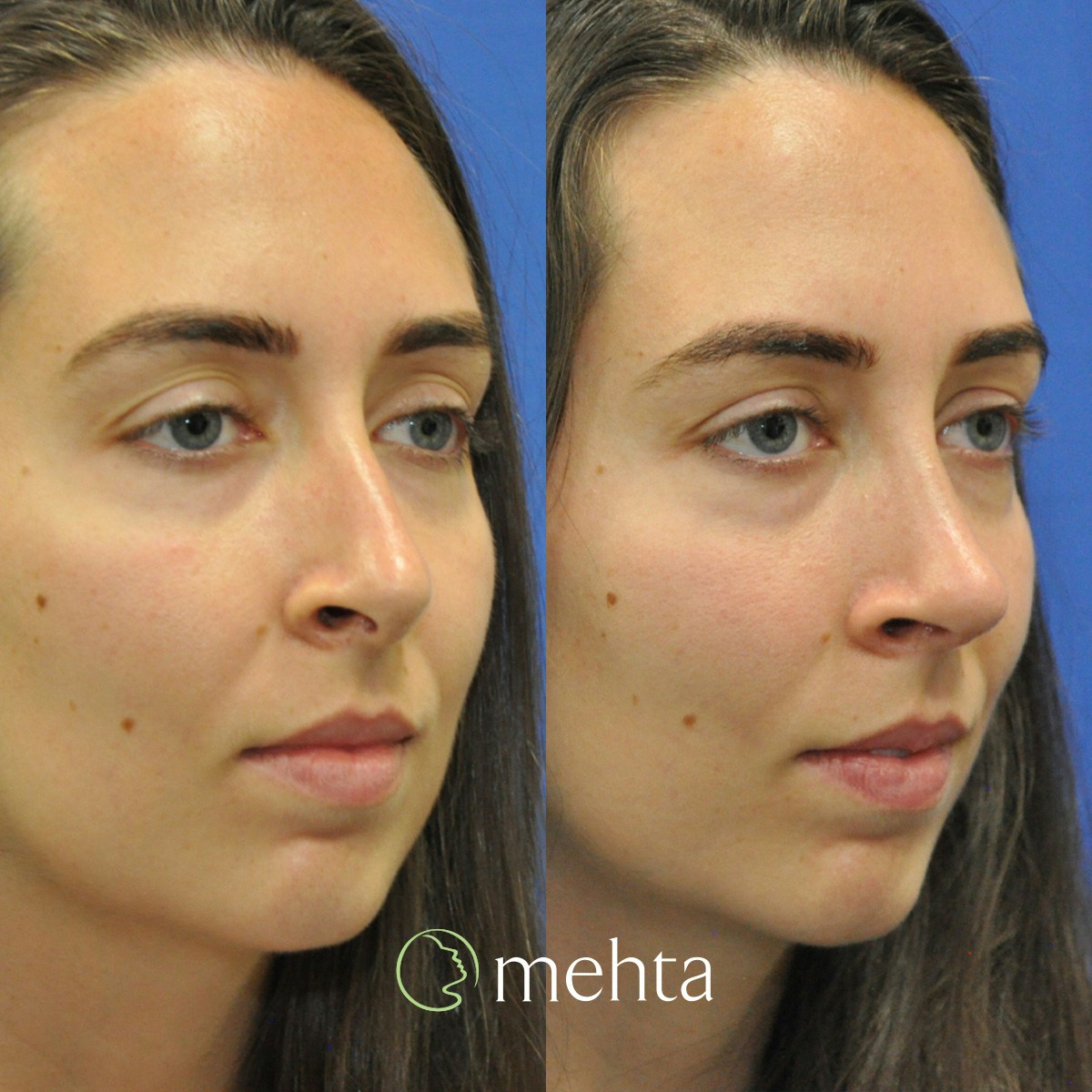 Rhinoplasty Before & After Gallery - Patient 259110 - Image 3