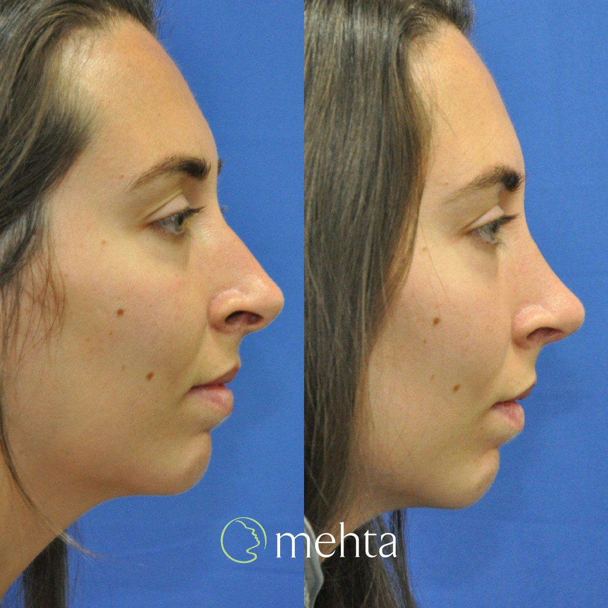 Rhinoplasty Before & After Gallery - Patient 259110 - Image 4
