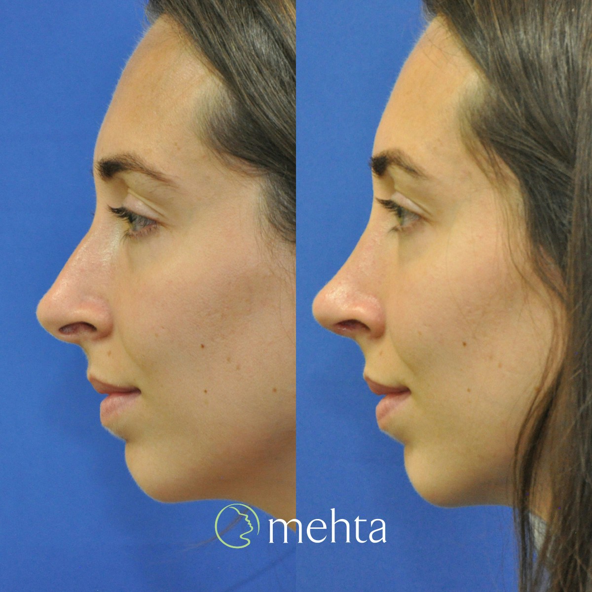 Rhinoplasty Before & After Gallery - Patient 259110 - Image 1