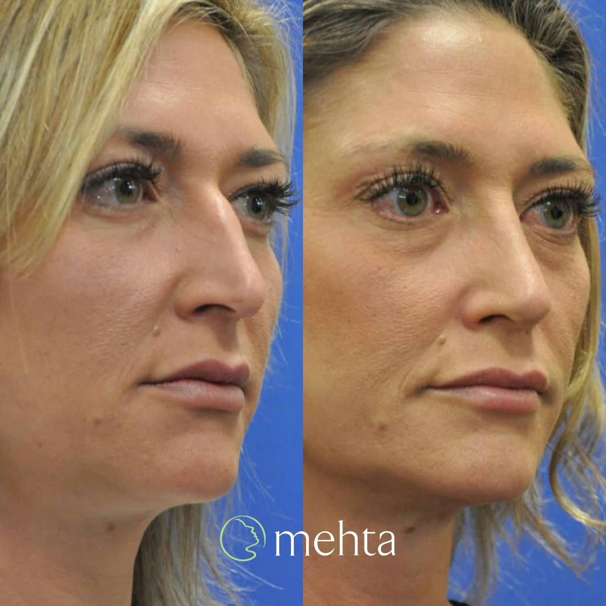 Rhinoplasty Before & After Gallery - Patient 207451 - Image 2