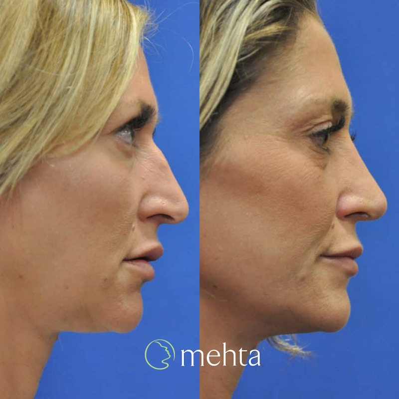 Rhinoplasty Before & After Gallery - Patient 207451 - Image 1