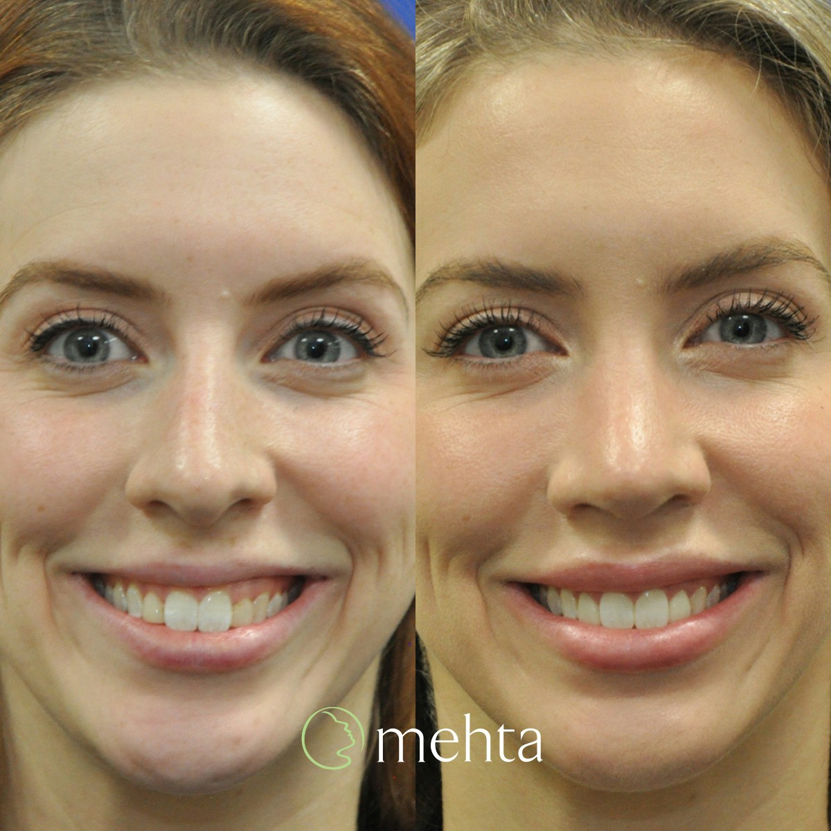 Rhinoplasty Before & After Gallery - Patient 158836 - Image 3