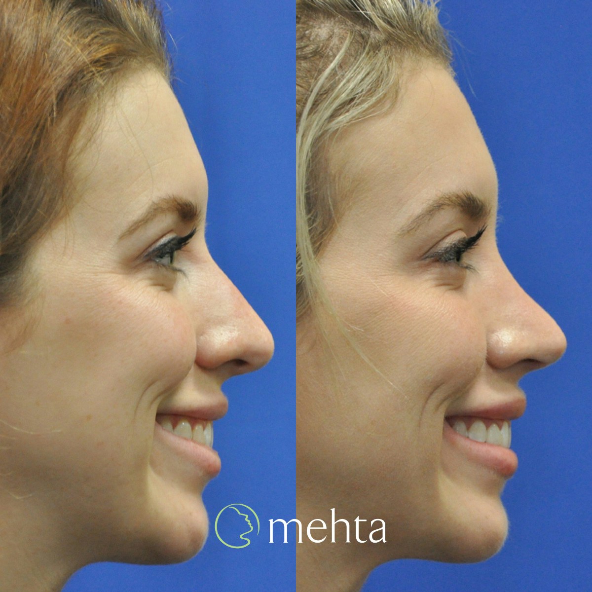 Rhinoplasty Before & After Gallery - Patient 158836 - Image 6