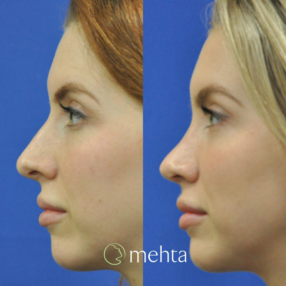 Rhinoplasty Before & After Gallery - Patient 158836 - Image 1