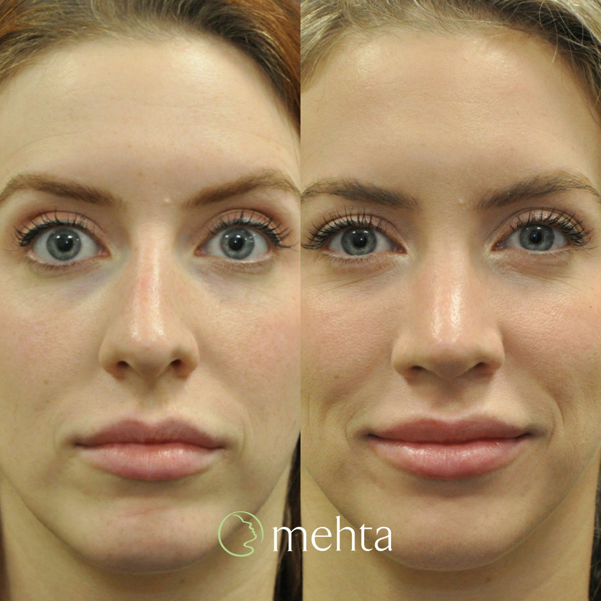 Rhinoplasty Before & After Gallery - Patient 158836 - Image 2
